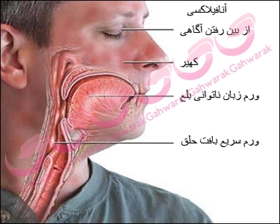 شوك آنافيلاكتيك چیست؟
