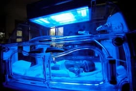 زردی در نوزادان نارس: علائم، علل و روش‌های درمان